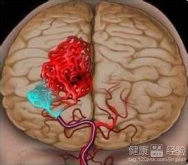 脑出血可以吃瓜,脑出血患者饮食调养指南